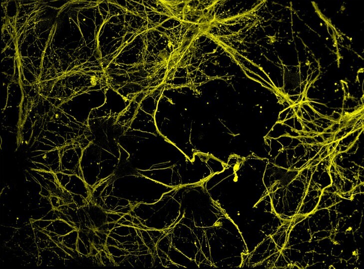 1_Anticorpi_Monoclonali_Alzheimer_Filippi_UniSR