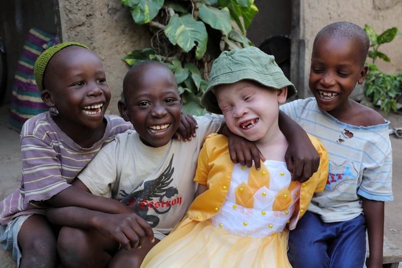 Albinism_awareness_day_superstition_discrimination_San_Raffaele_University (4)