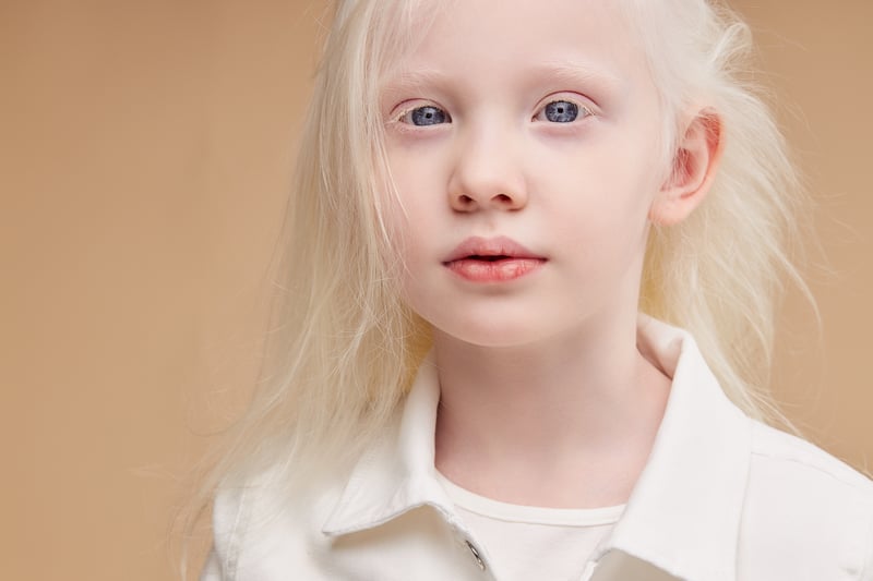 Albinism_awareness_day_superstition_discrimination_San_Raffaele_University (8)