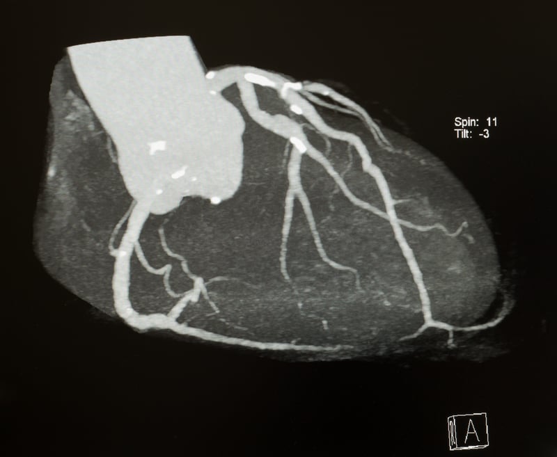 AI_Cuore_imaging_diagnosi_coronarie_infarto_miocardio_UniSR (2)