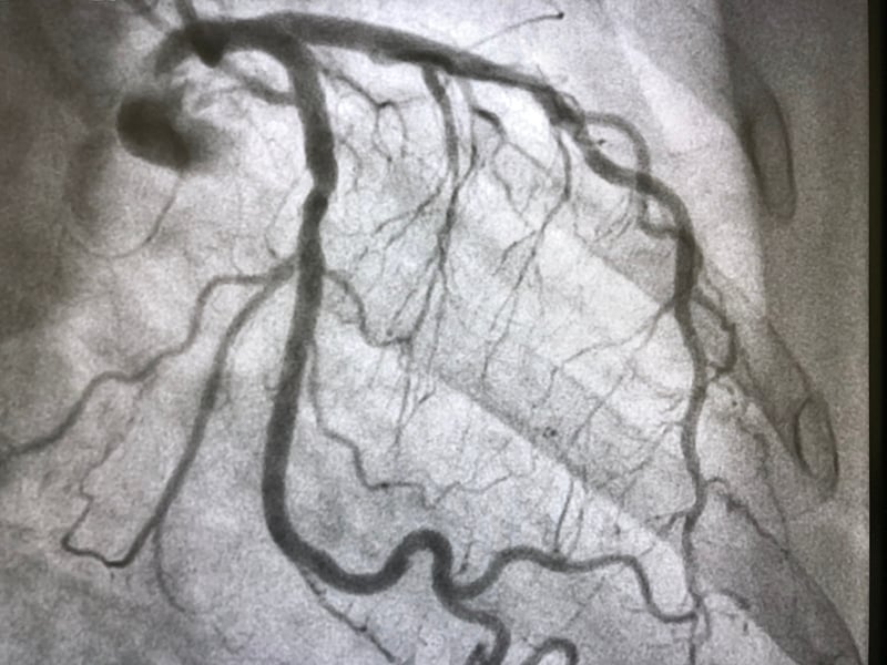 AI_Cuore_imaging_diagnosi_coronarie_infarto_miocardio_UniSR (5)