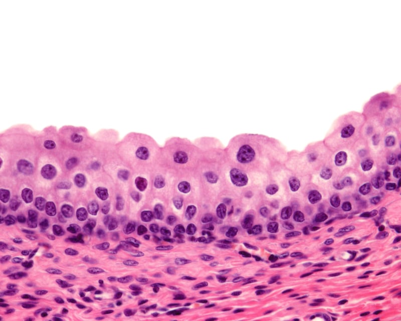 Tumore_vescica_muscolo_infiltrante_UniSR_San_Raffaele (2)