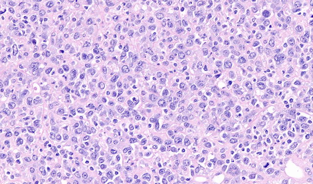 chronic lymphocytic leukemia