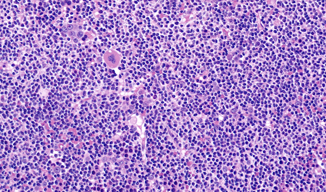 immunophenotype B diffuse large cell lymphoma