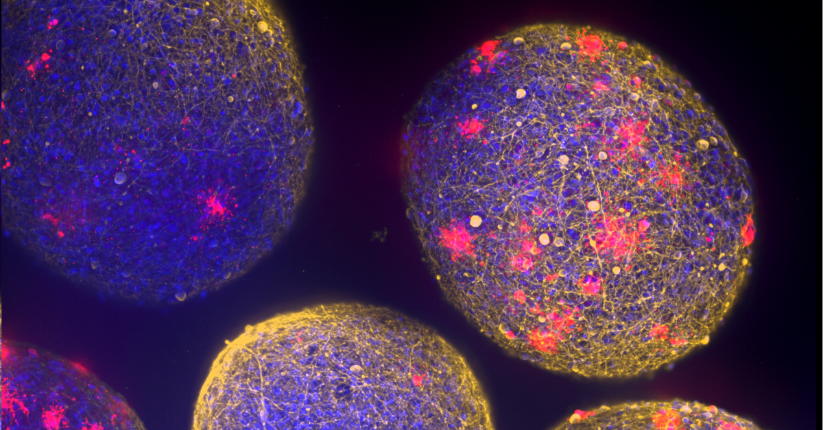 Il ritorno di bavisant nella ricerca sulla sclerosi multipla