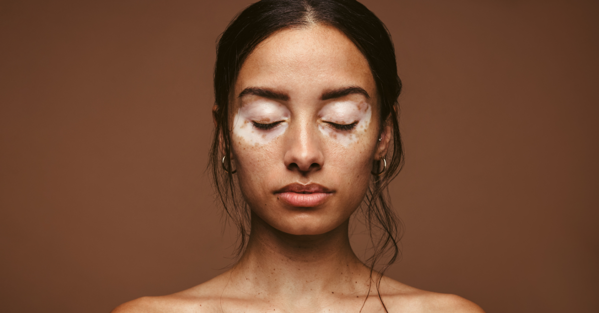 Vitiligo: causes, treatments and importance of emotional support